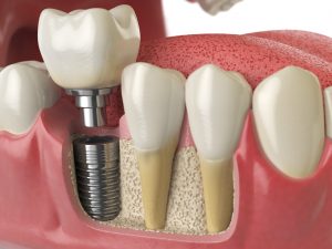 does Medicare cover dental implants?